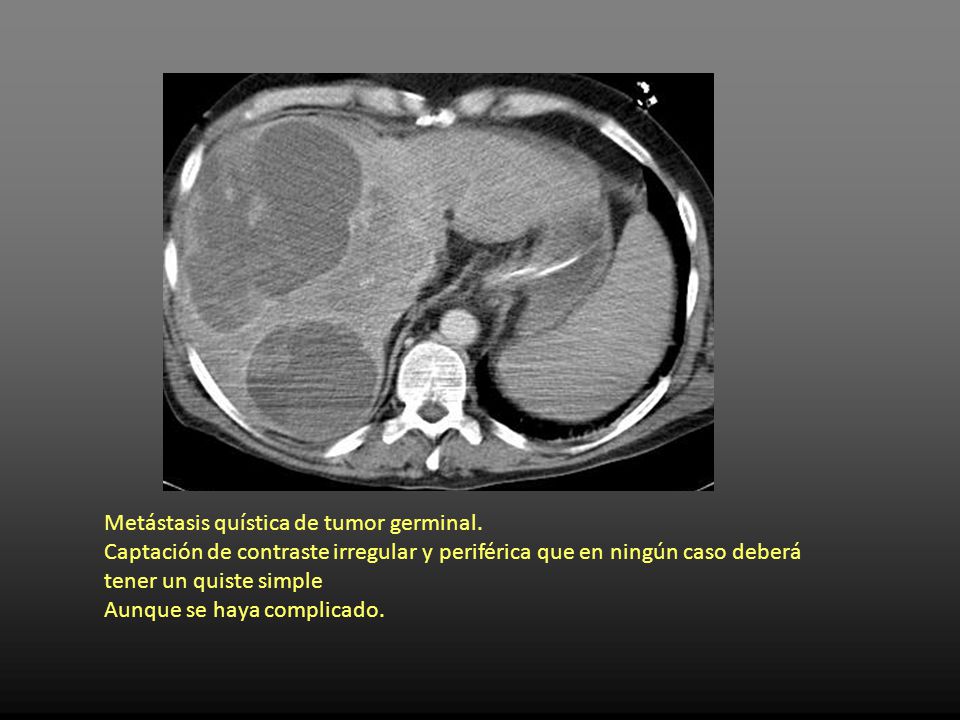 Quiste hepatico simple complicado